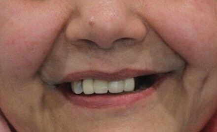Patient smile before dental treatment