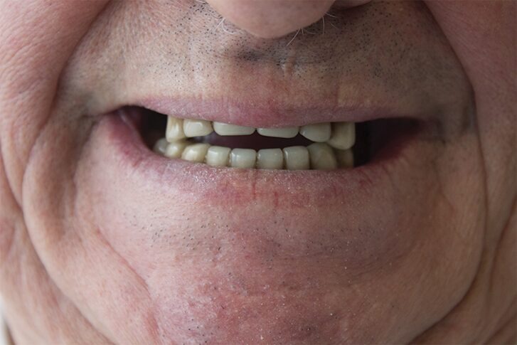 Patient smile before dental treatment