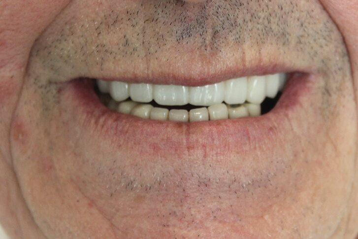 Patient smile after dental treatment