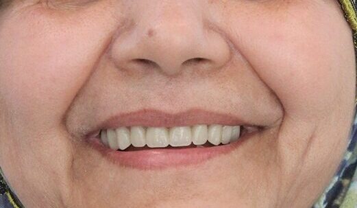 Patient smile after dental treatment