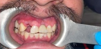 Patient smile before dental treatment